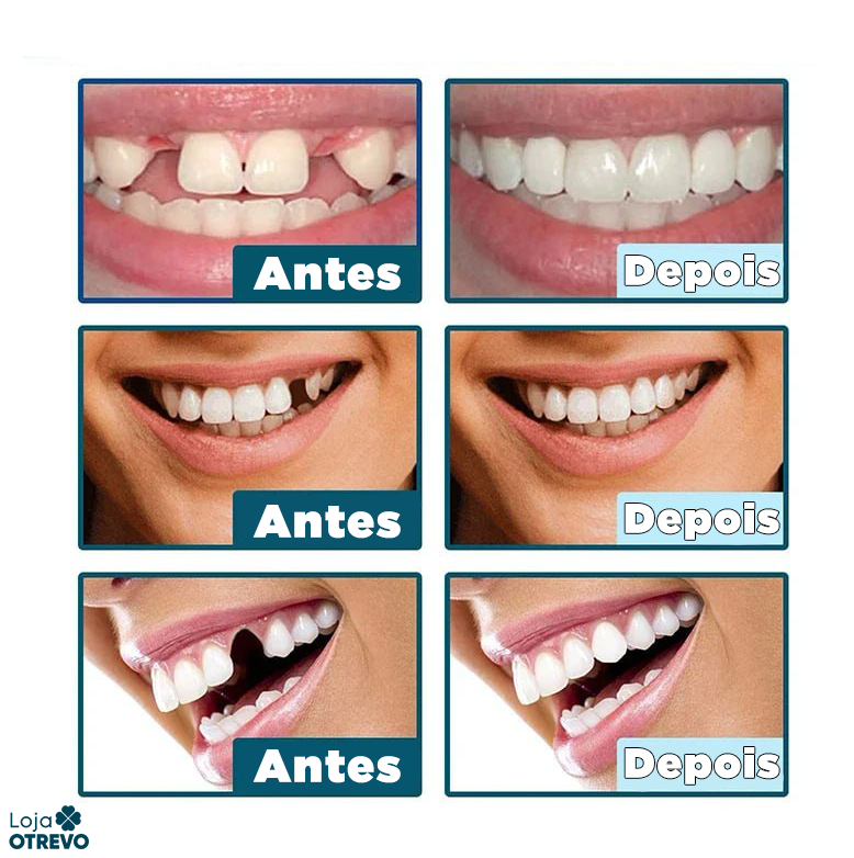 (Compre 1 Leve 2) Lente Dental Ajustável - Inferior e Superior | BRINDE CAPINHA PROTETORA + FRETE GRÁTIS!