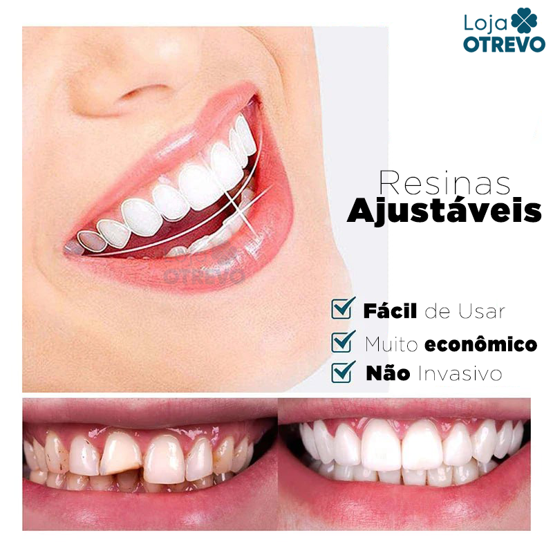 (Compre 1 Leve 2) Lente Dental Ajustável - Inferior e Superior | BRINDE CAPINHA PROTETORA + FRETE GRÁTIS!